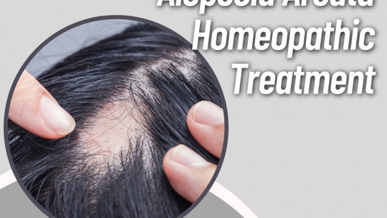 Effective Homeopathic Medicine for Alopecia Areata in India