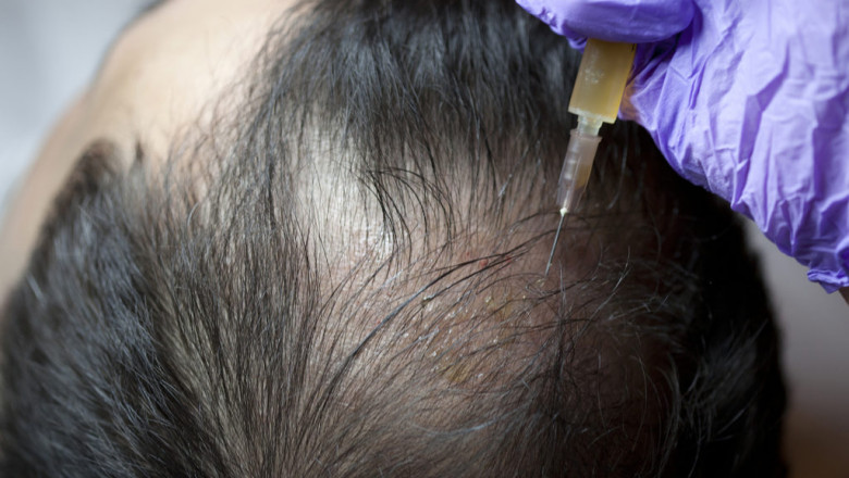 How to describe the treatment of Platelet-rich plasma (PRP) therapy?