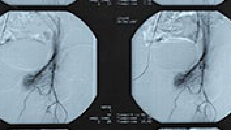 Trends | Updates | News On Embolotherapy Market