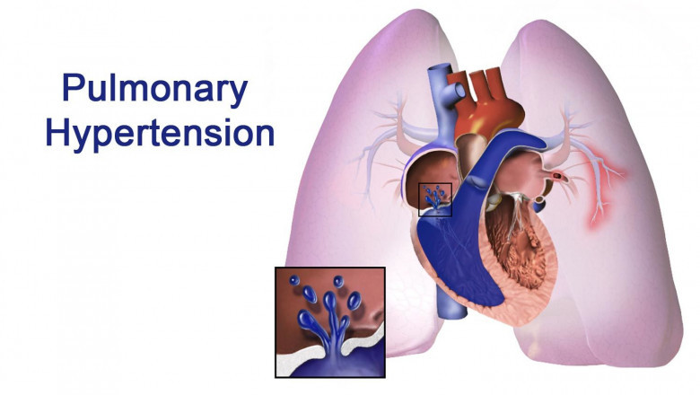 Pulmonary Arterial Hypertension Market Rising Awareness