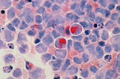 Rising Investments in the Creation Of Cutting-Edge Technology and an Increase in the Number of New Markets Will Present Favourable Prospects for the Expansion of the Solid Tumors Treatment Market