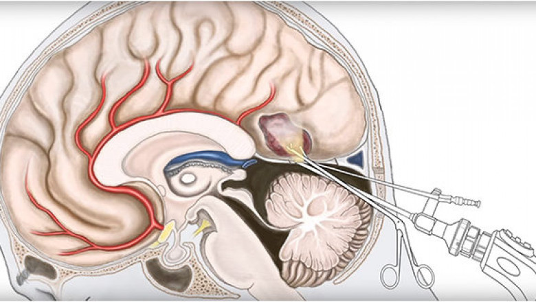 Neuroendoscopy Market Size, Growth & Global Forecast Report to 2028