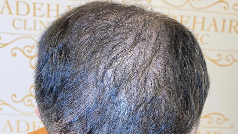 Made Hair Academy Explaining Scalp Micropigmentation Thoroughly for You