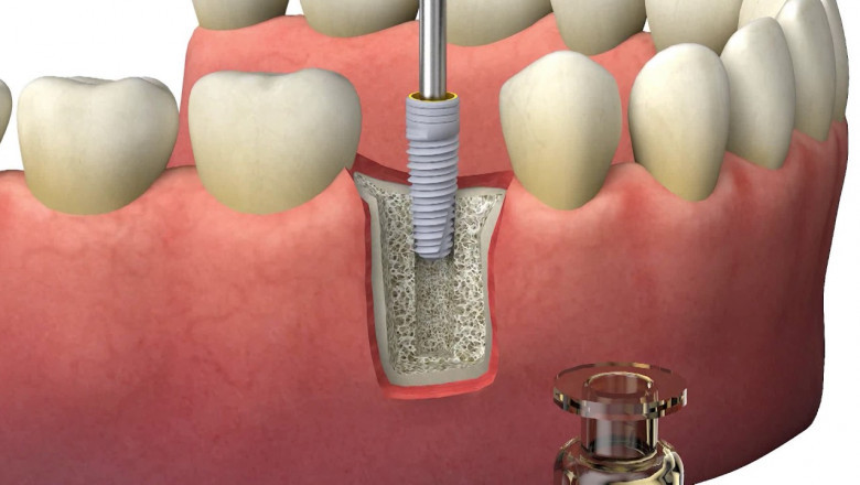 A Bio-Implant Is an Organism or Organisms that Work Together to Improve Soil Fertility