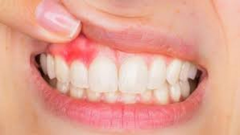 Is Wisdom tooth extraction painless?