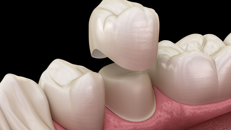 What Are the Major Benefits of Root Canal Treatment?