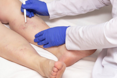 How Can You Limit The Effect Of Varicose Veins?