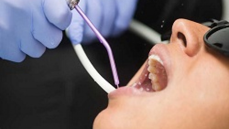 What Are the Teeth Whitening Products and Other at-home Options?