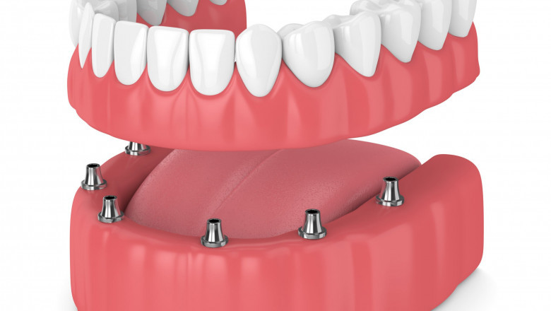 Why Would Someone Need A Dental Crown?