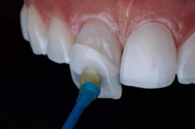 How To Fix Your Crooked Yellow Teeth Instantly?