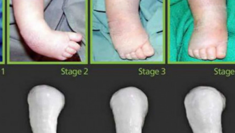 Dr Gaurav Jain | Best Orthopedic Surgeon in Indore - Top Rated Doctors for Clubfoot in Bhopal