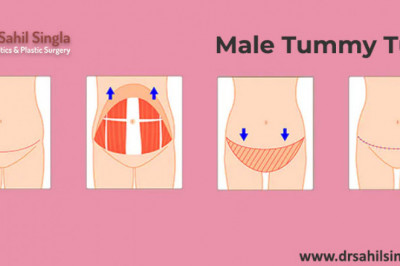 Men's Tummy Tuck: what you can expect?