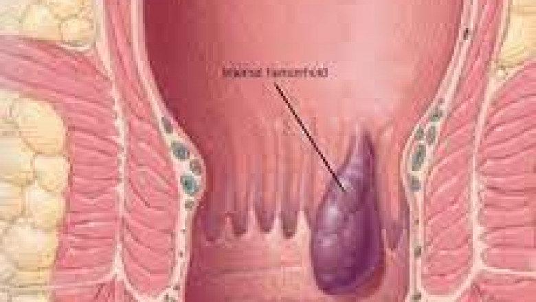 Painless and best ayurvedic result for Piles in Delhi.