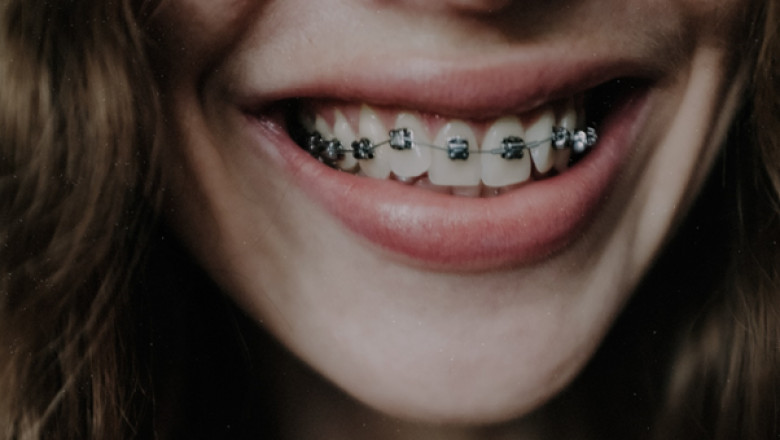 What Are The Uses Of Braces?