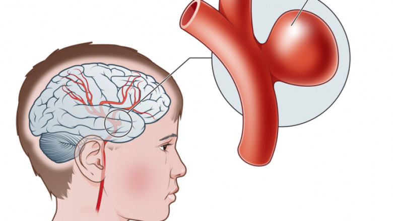 Give a brief classification of the endovascular coiling procedure?