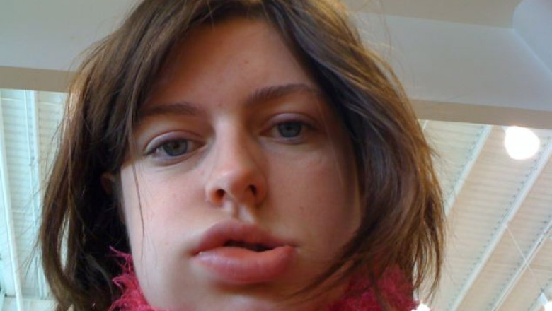 Symptoms of hereditary angioedema include recurrent bouts of swelling