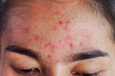 What is erysipelas?