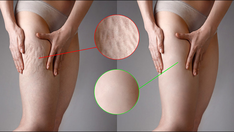 What To Know About Cellulite Reduction