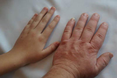 New Acromegaly Treatments Are Becoming Available With Increased Research and Development Activities