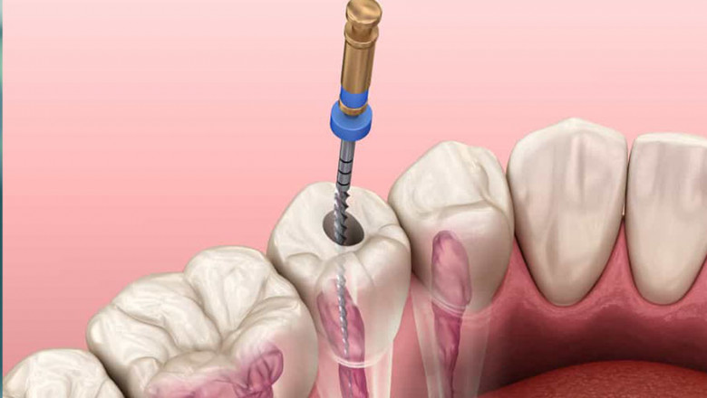 Root Canal Treatment Dentist