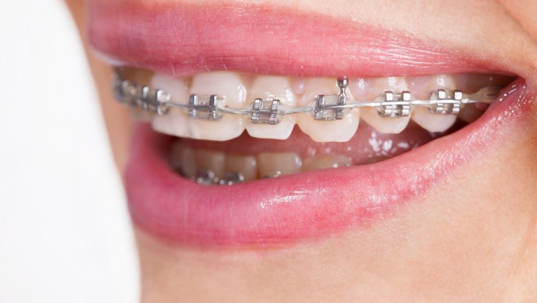 What Types Of Braces Work Best For Overbites?