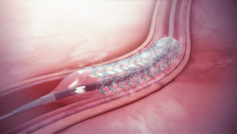 The Drug Eluting Stents Market is Expected to Grow due to Factors Such as the Rising Prevalence of Cardiovascular Diseases