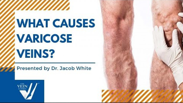 What Causes Varicose Veins? by Dr. Jacob White [WEBINAR]