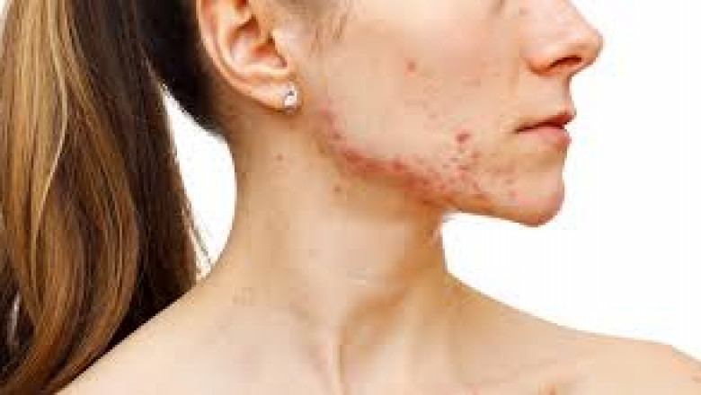 How to Be Kind to Yourself When You Have Psoriasis? Find the Right Treatment for Psoriasis