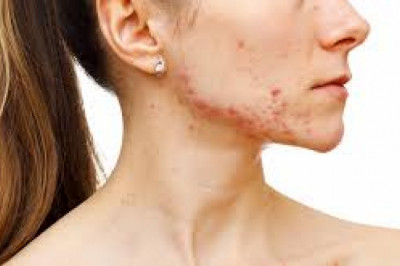 How to Be Kind to Yourself When You Have Psoriasis? Find the Right Treatment for Psoriasis