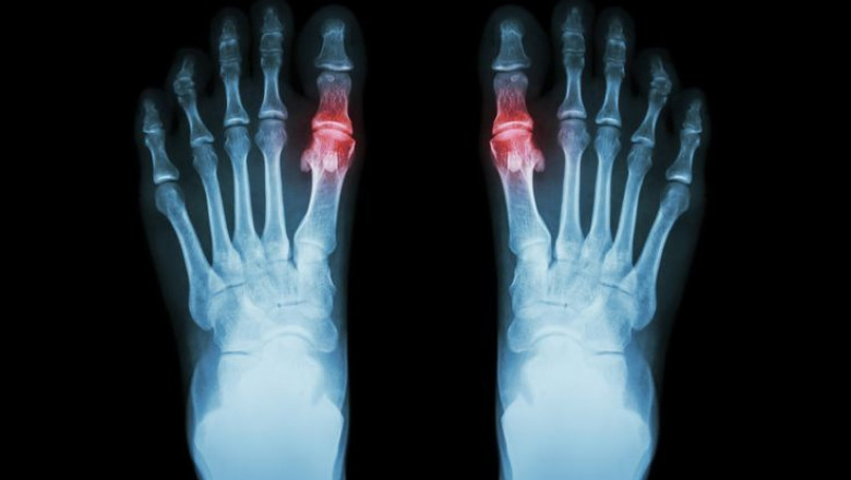 How do uric acid monitors work?