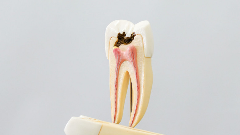 What are the 4 Stages of a Root Canal Treatment?