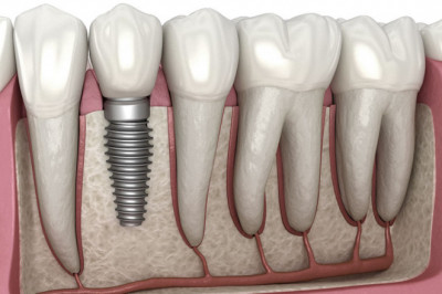 What Are the Common Invisalign Faqs?