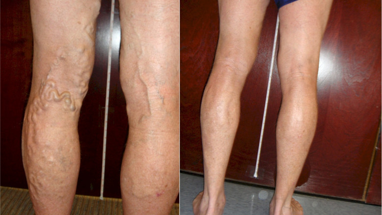 How to treat varicose veins?