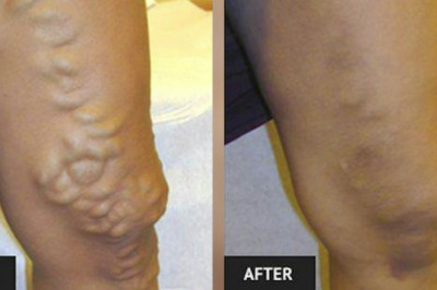 What Risk Factors Associates With Varicose Veins?