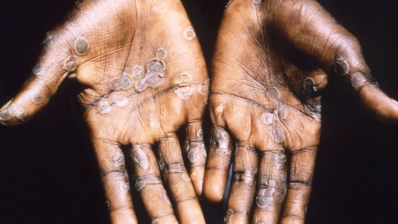Monkeypox in Africa