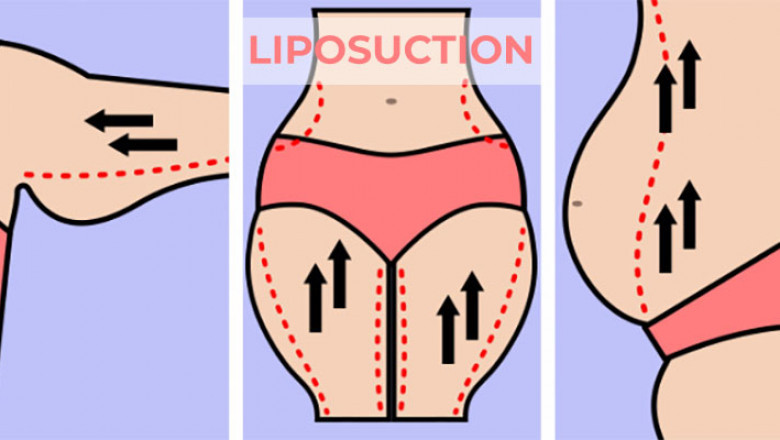 Liposuction, everything you need to know