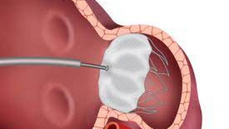 Global Left Atrial Appendage Closure Device Market 2022: COVID-19 Impact Analysis and Industry Forecast Report, 2028