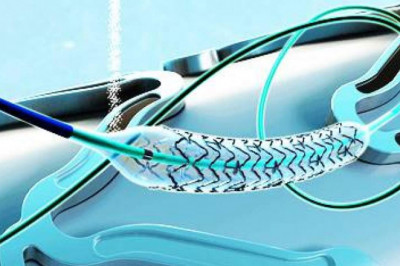 The Global Neurovascular Devices Market is Classified by Product, Disease Pathology, and Region