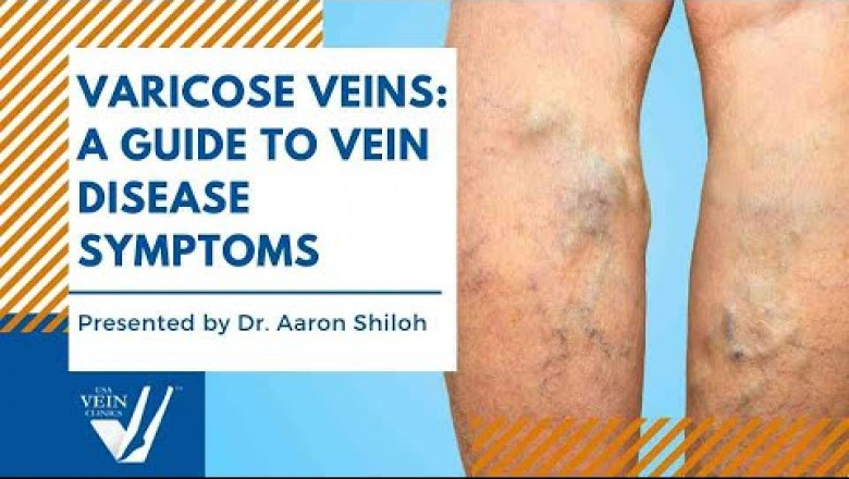 Varicose Veins: A Guide to Vein Disease Symptoms