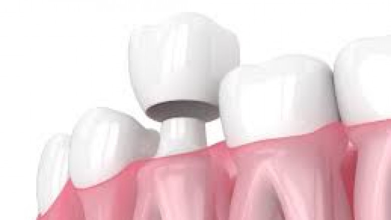Wish to prolong the life of your tooth? Then, a dental crown is the best choice!