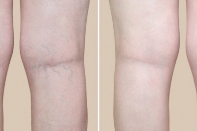 How Do Doctors Test And Diagnose Varicose Veins?