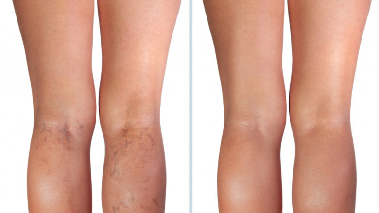 What is the Frequently Asked Question About Varicose and Spider Veins and Their Treatment?
