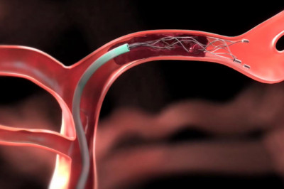 Thrombectomy device Market Research Report - Competitive Analysis and Forecast period during 2022-2027