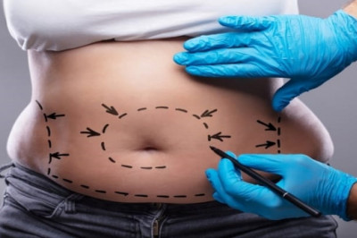 Abdominoplasty: know the risks in the postoperative period