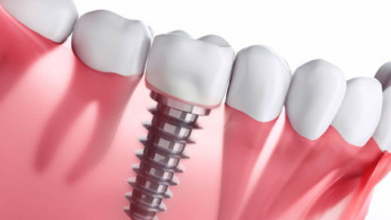 Affordable Indian Land Sc Dentist | Carolinasmiledentistry.com