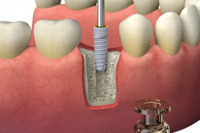 An organism or organisms that collaborate to increase soil fertility are known as bio-implants.