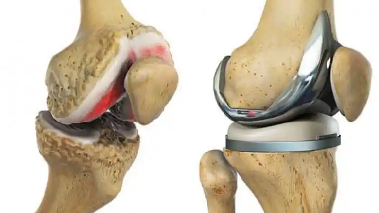 Knee Replacement Surgery Cost in Delhi