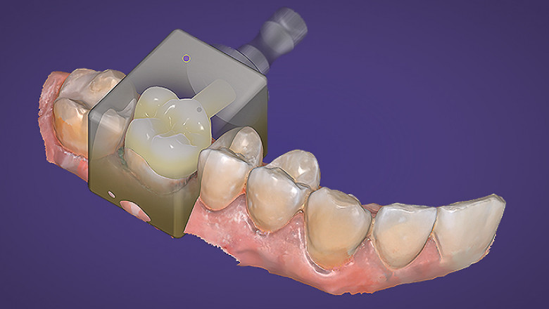 Exocadexperts Will Help You Find the Best Dental Software