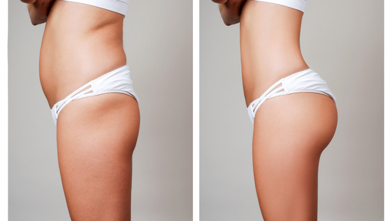 What Are Hip Dips?