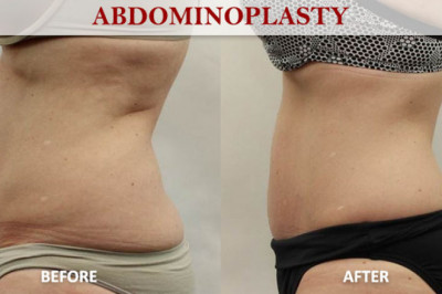 What is abdominoplasty and why is it performed?